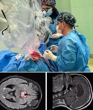 عمل جراحی تومور داخل بطن مغز، برای اولین بار در استان ایلام انجام شد